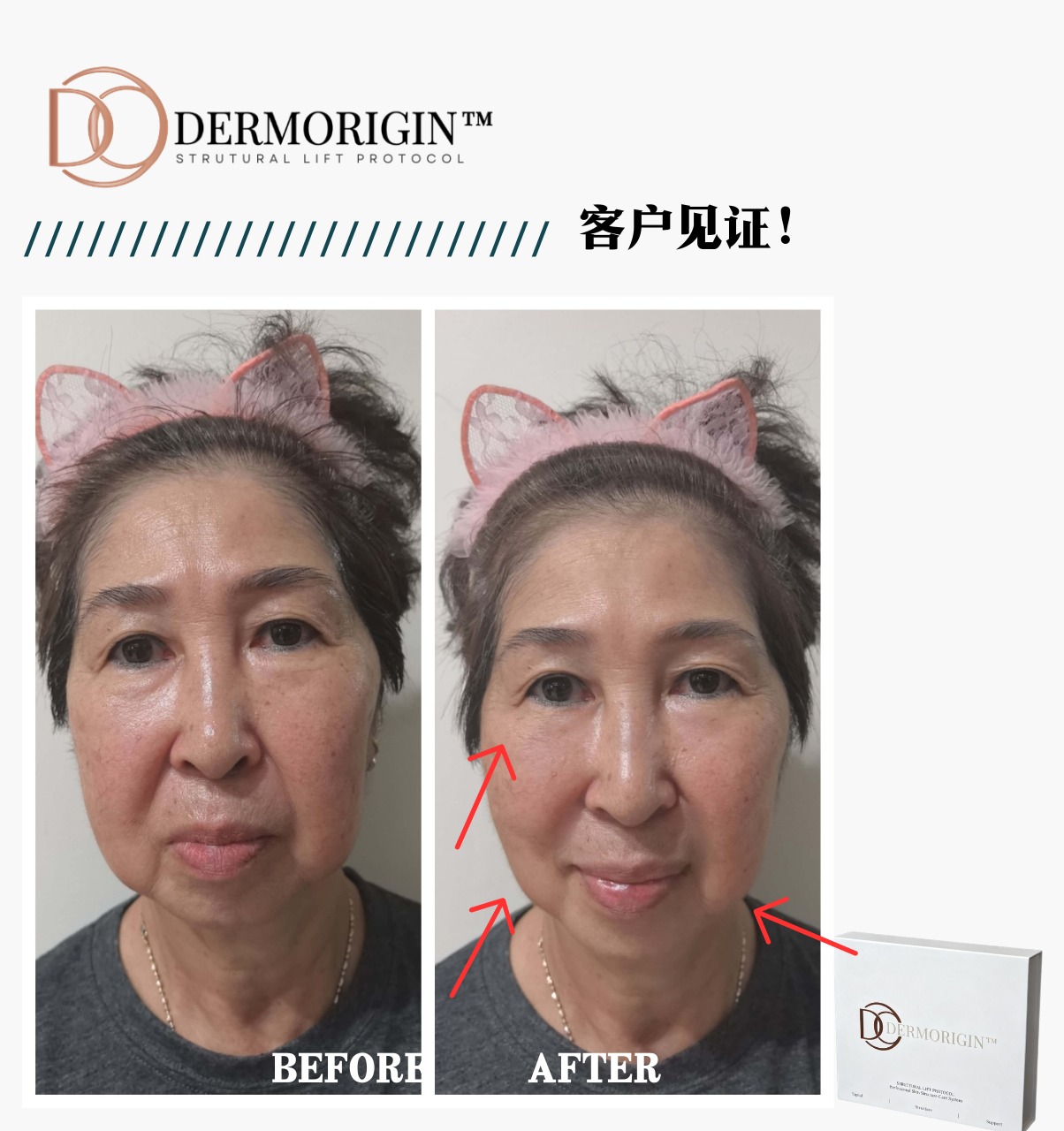 DERMORIGIN Structural Lift Protocol 客户见证，使用前后对比