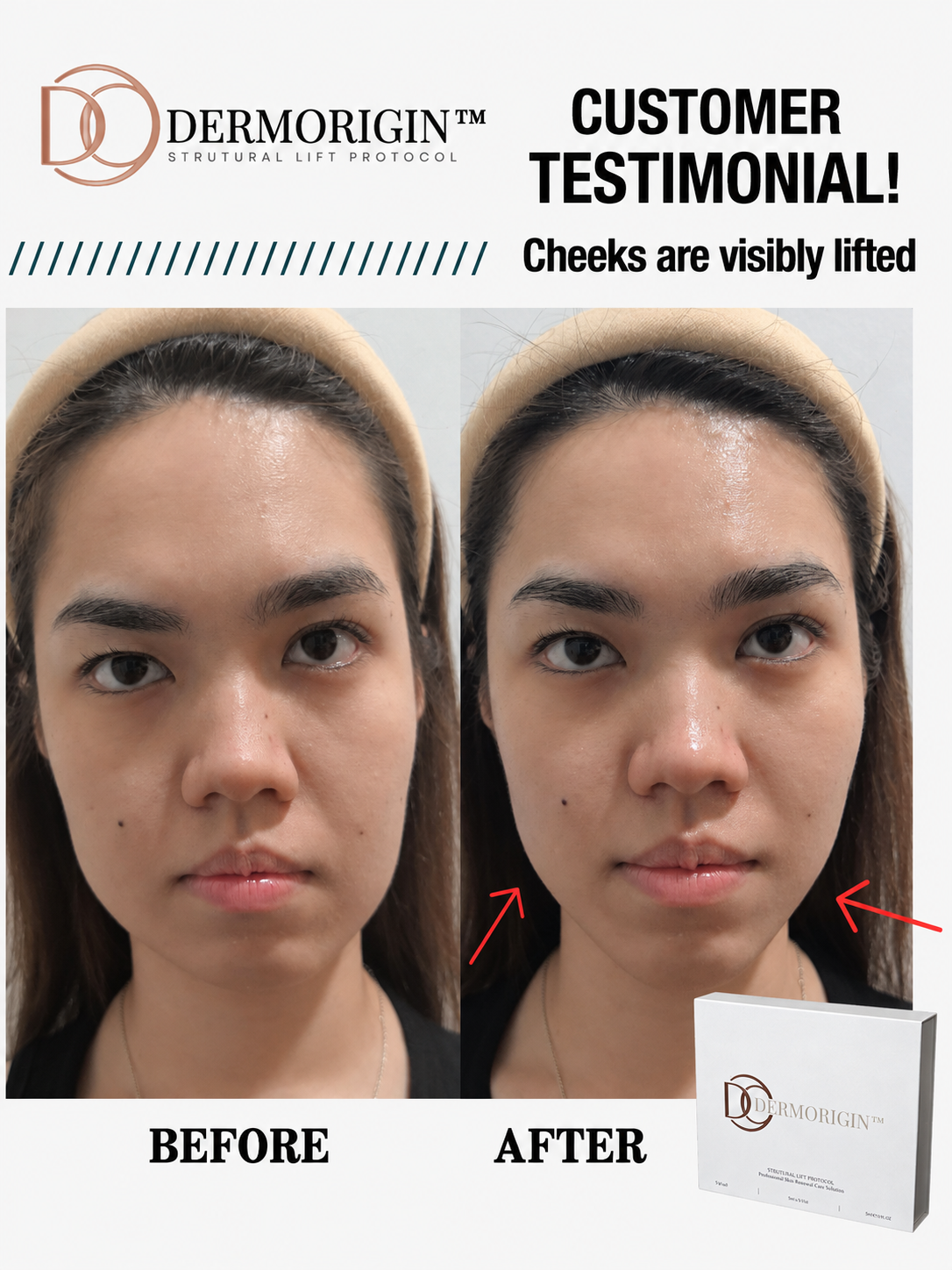 DERMORIGIN Structural Lift Protocol client testimonial, cheeks are visibly lifted