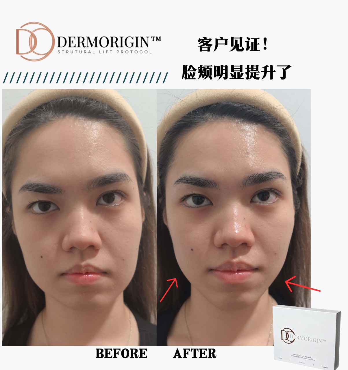 DERMORIGIN Structural Lift Protocol 客户见证，脸颊明显提升
