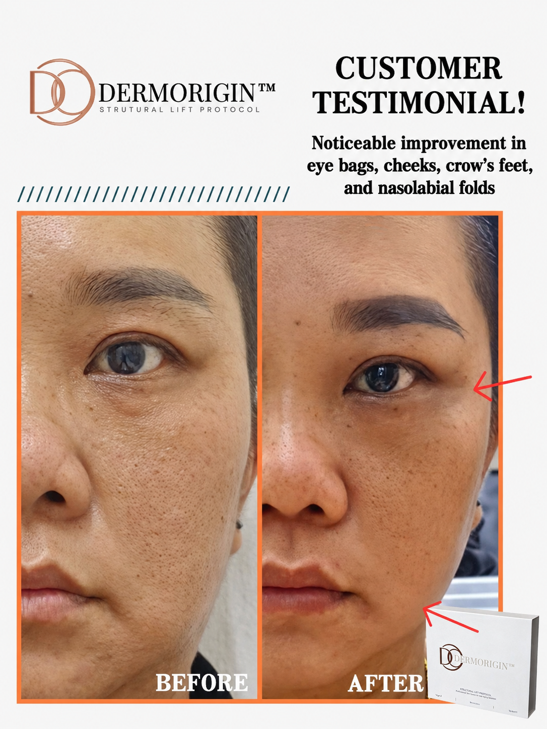 DERMORIGIN Structural Lift Protocol client testimonial, noticeable improvement in eye bags, cheeks, crow’s feet, and nasolabial folds