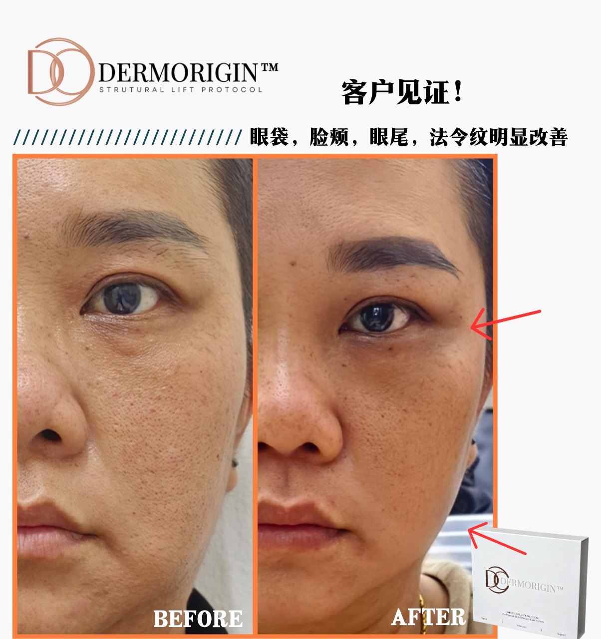 DERMORIGIN Structural Lift Protocol 客户见证，眼袋、脸颊、眼尾、法令纹明显改善