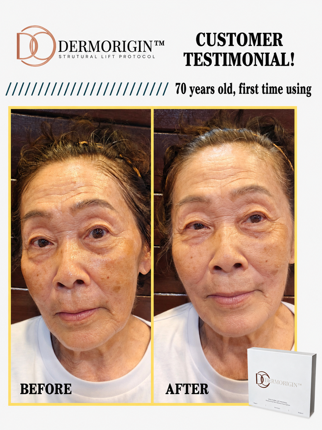 DERMORIGIN Structural Lift Protocol client testimonial, 70 years old, first time using