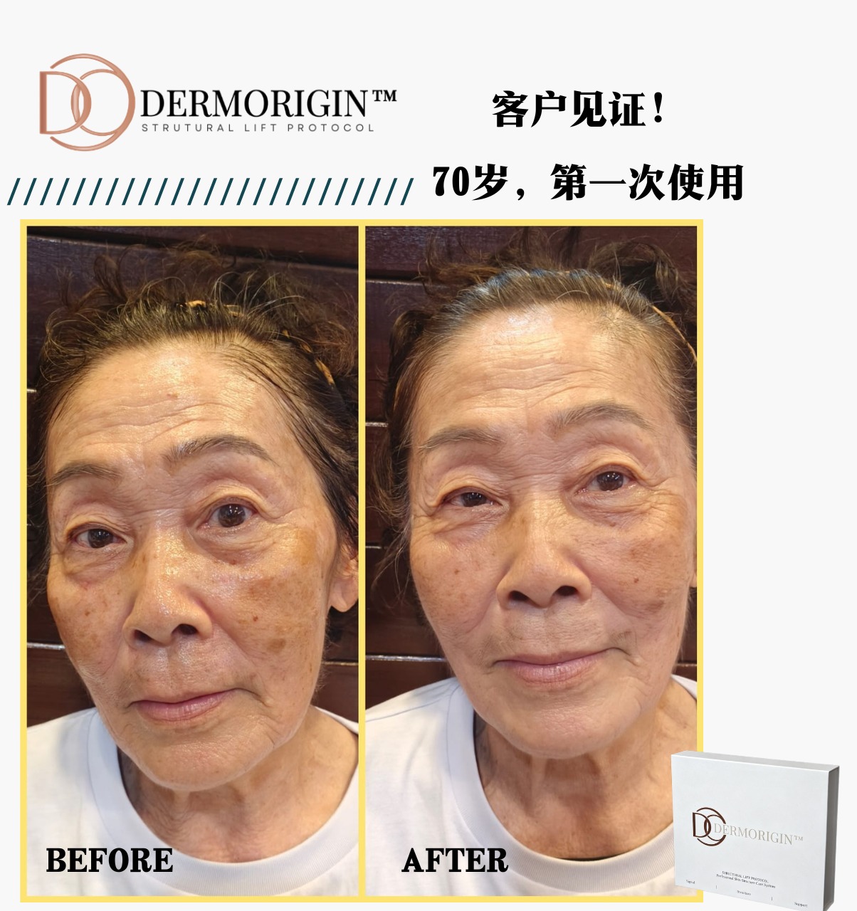 DERMORIGIN Structural Lift Protocol 客户见证，70岁，第一次使用